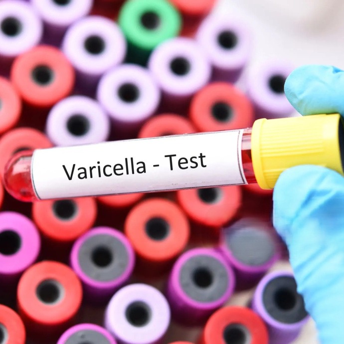 Varicella Antibody test