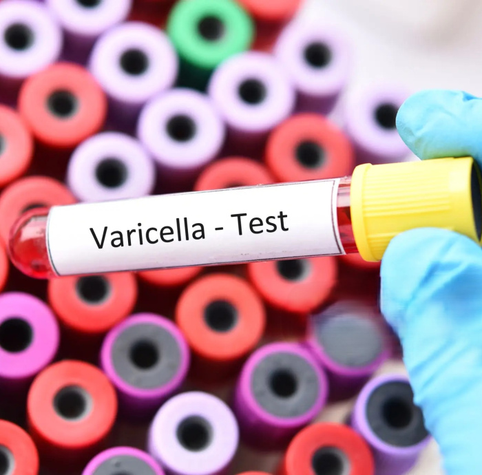 Varicella Antibody test